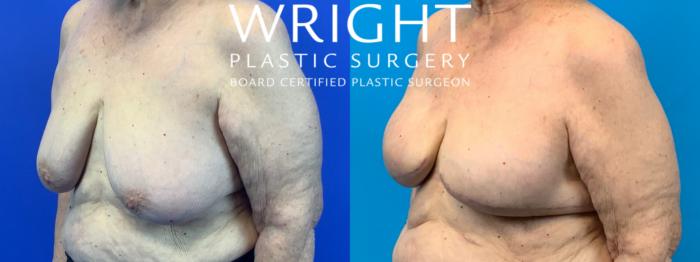 Before & After Breast Reconstruction Case 192 Left Oblique View in Little Rock, Arkansas