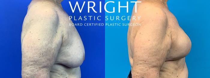 Before & After Breast Reconstruction Case 192 Right Side View in Little Rock, Arkansas