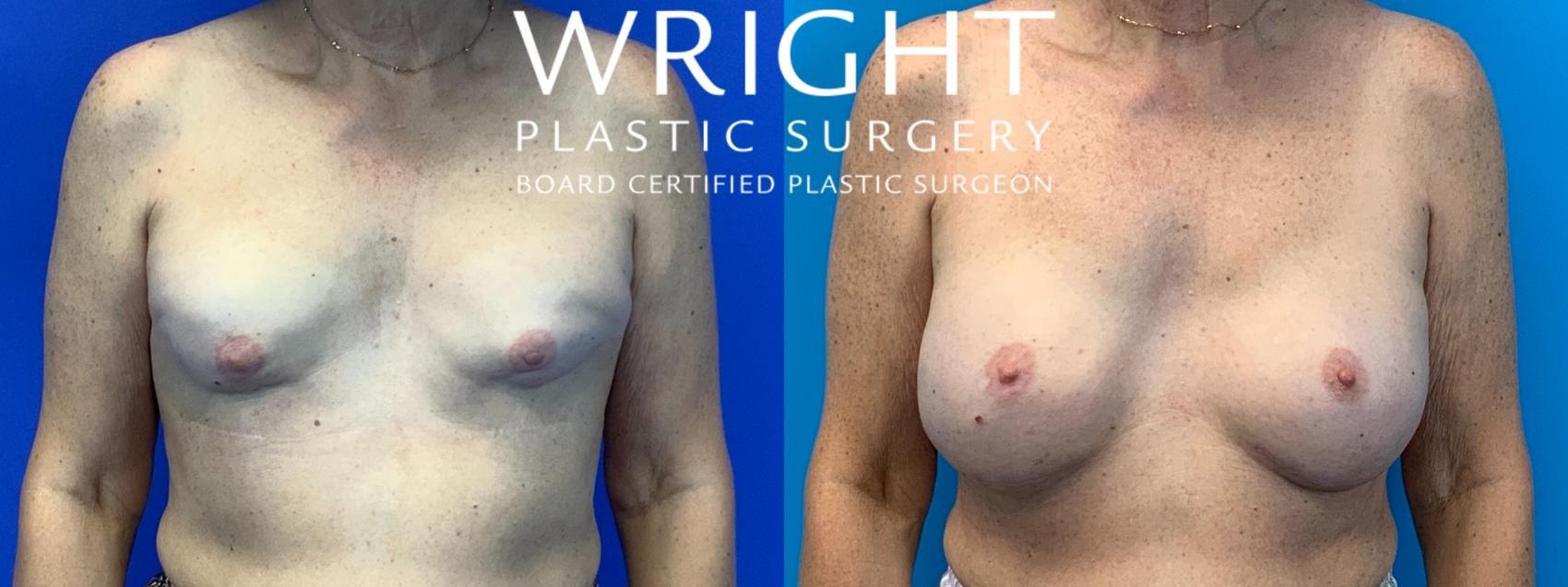 Before & After Breast Reconstruction Case 200 Front View in Little Rock, Arkansas