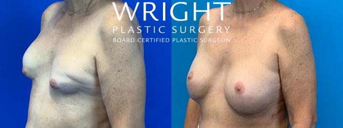 Before & After Breast Reconstruction Case 200 Left Oblique View in Little Rock, Arkansas
