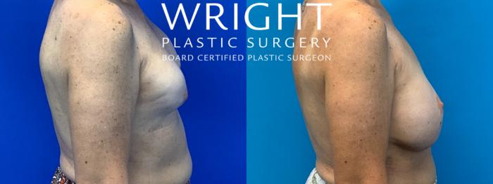 Before & After Breast Reconstruction Case 200 Right Side View in Little Rock, Arkansas