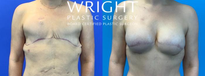Before & After Breast Reconstruction Case 319 Front View in Little Rock, Arkansas