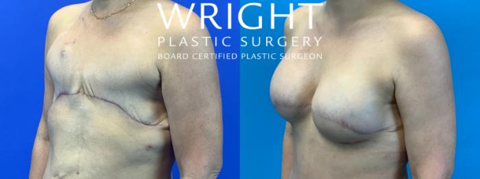 Before & After Breast Reconstruction Case 319 Left Oblique View in Little Rock, Arkansas