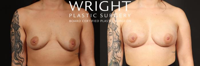 Before & After Breast Reconstruction Case 491 Front View in Little Rock, Arkansas