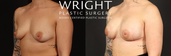 Before & After Breast Reconstruction Case 491 Left Oblique View in Little Rock, Arkansas