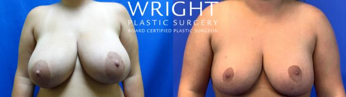Before & After Breast Reduction Case 109 Front View in Little Rock, Arkansas