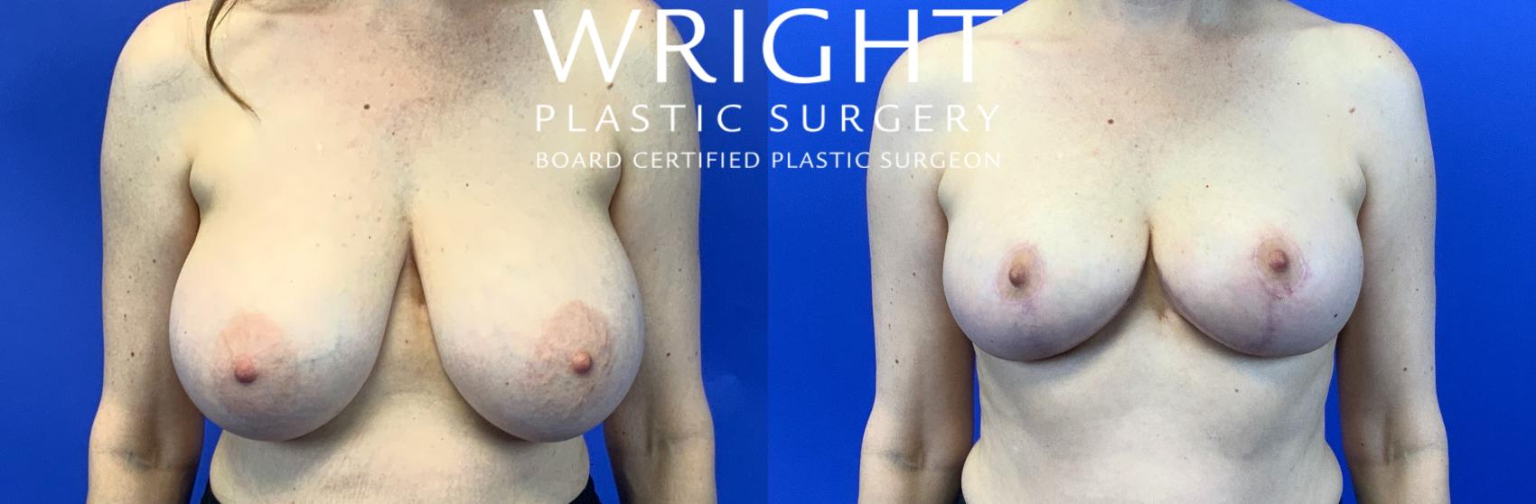 Before & After Breast Reduction Case 125 Front View in Little Rock, Arkansas