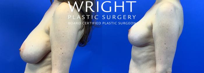 Before & After Breast Reduction Case 125 Left Side View in Little Rock, Arkansas