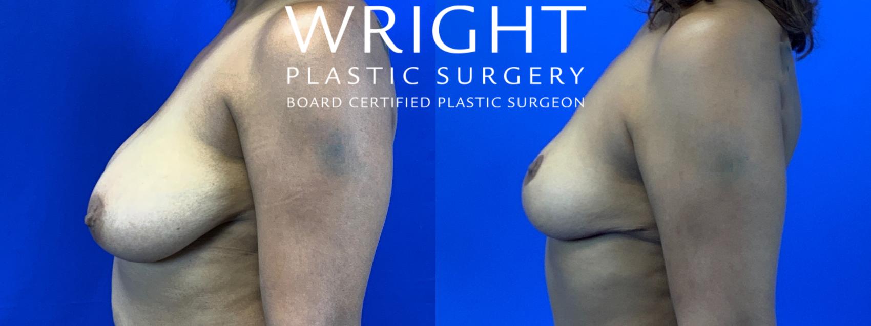 Before & After Breast Reduction Case 127 Left Side View in Little Rock, Arkansas