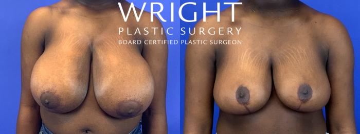 Before & After Breast Reduction Case 128 Front View in Little Rock, Arkansas