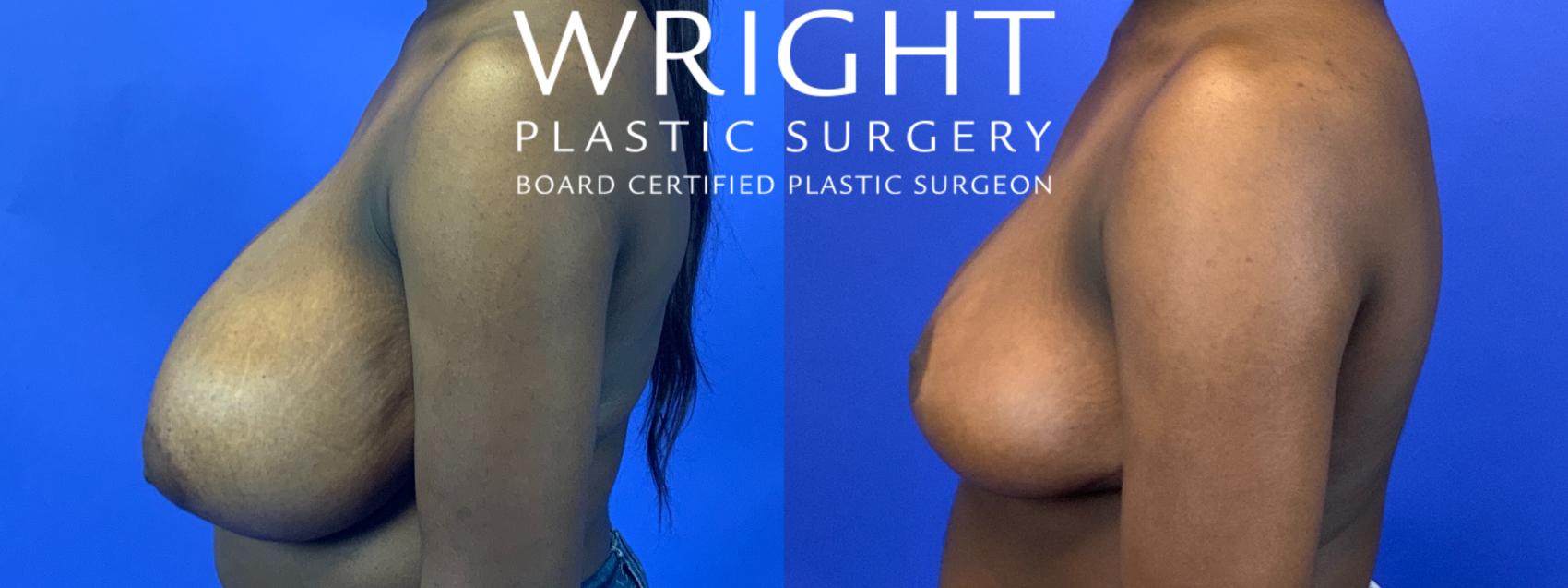 Before & After Breast Reduction Case 128 Left Side View in Little Rock, Arkansas