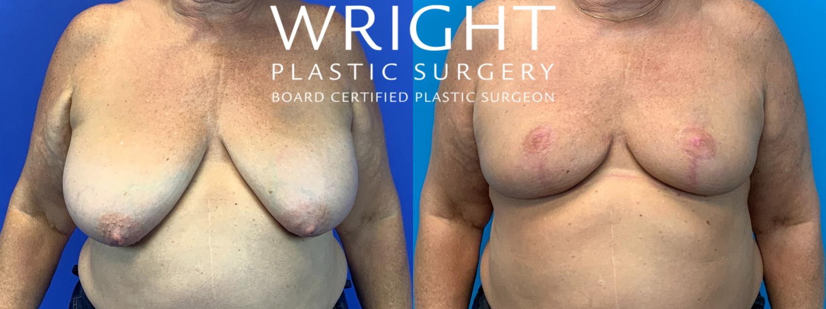 Before & After Breast Reduction Case 134 Front View in Little Rock, Arkansas
