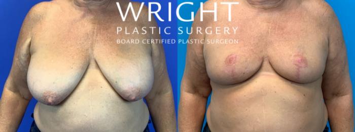 Before & After Breast Reduction Case 134 Front View in Little Rock, Arkansas