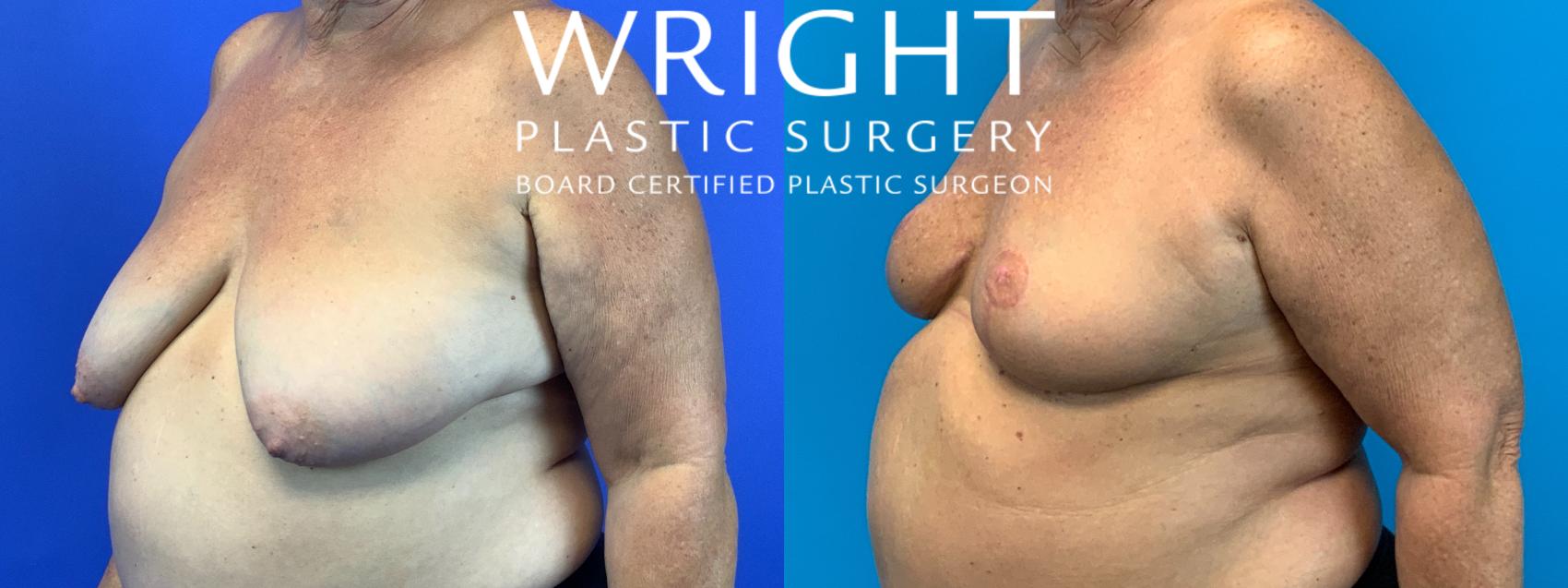 Before & After Breast Reduction Case 134 Left Oblique View in Little Rock, Arkansas