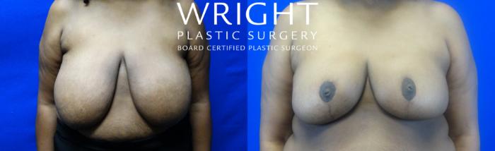 Before & After Breast Reduction Case 14 Front View in Little Rock, Arkansas