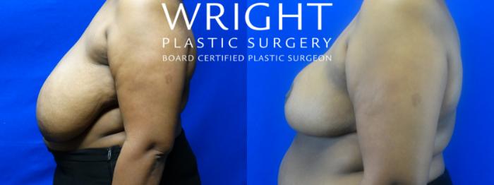 Before & After Breast Reduction Case 14 Left Side View in Little Rock, Arkansas