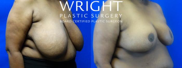 Before & After Breast Reduction Case 14 Right Oblique View in Little Rock, Arkansas