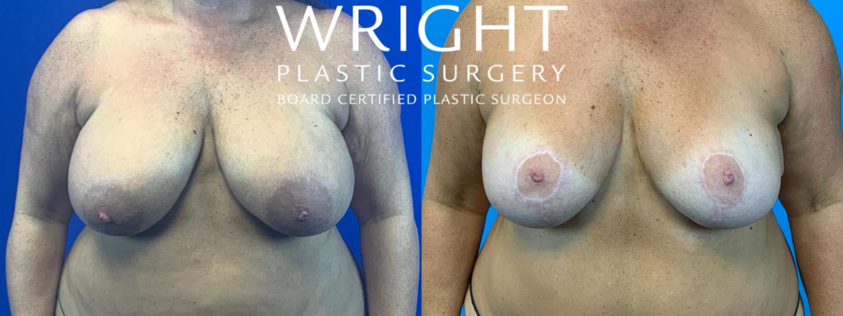 Before & After Breast Reduction Case 155 Front View in Little Rock, Arkansas