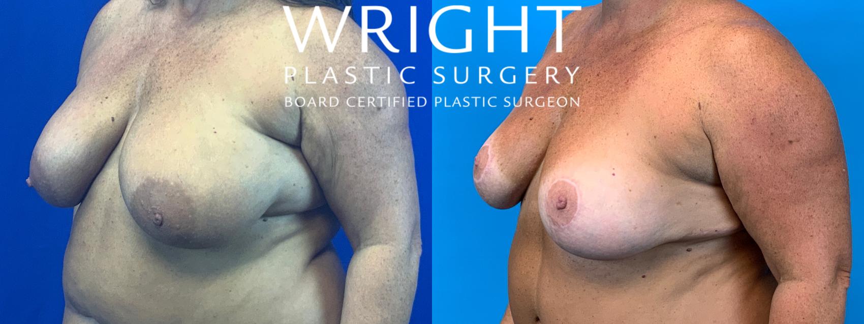 Before & After Breast Reduction Case 155 Left Oblique View in Little Rock, Arkansas