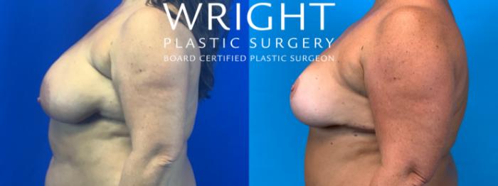 Before & After Breast Reduction Case 155 Left Side View in Little Rock, Arkansas
