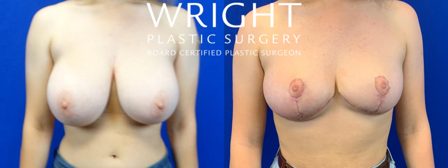 Before & After Breast Reduction Case 167 Front View in Little Rock, Arkansas