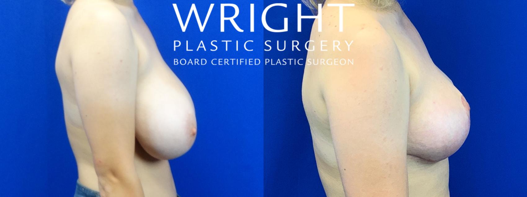 Before & After Breast Reduction Case 167 Right Side View in Little Rock, Arkansas