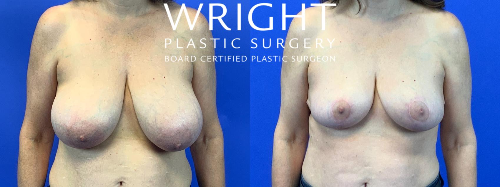Before & After Breast Reduction Case 168 Front View in Little Rock, Arkansas