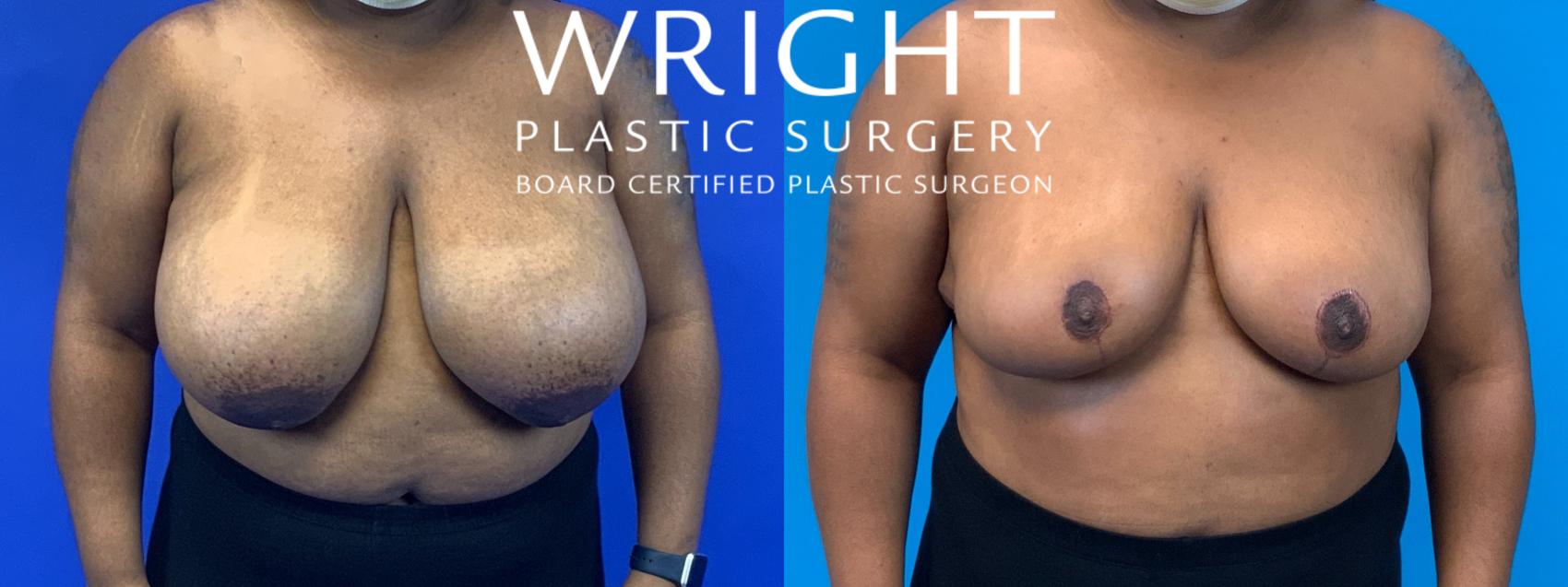 Before & After Breast Reduction Case 171 Front View in Little Rock, Arkansas