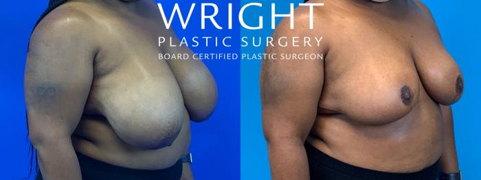 Before & After Breast Reduction Case 171 Right Oblique View in Little Rock, Arkansas