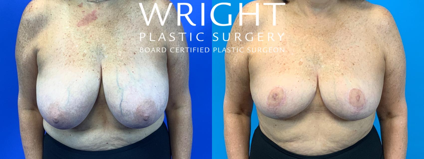 Before & After Breast Reduction Case 174 Front View in Little Rock, Arkansas