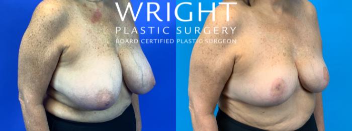 Before & After Breast Reduction Case 174 Right Oblique View in Little Rock, Arkansas