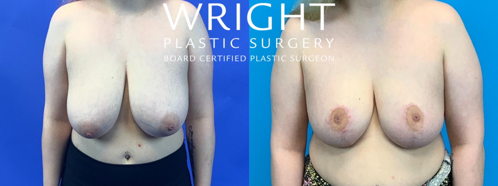 Before & After Breast Reduction Case 181 Front View in Little Rock, Arkansas