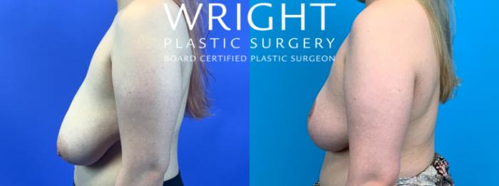 Before & After Breast Reduction Case 181 Left Side View in Little Rock, Arkansas