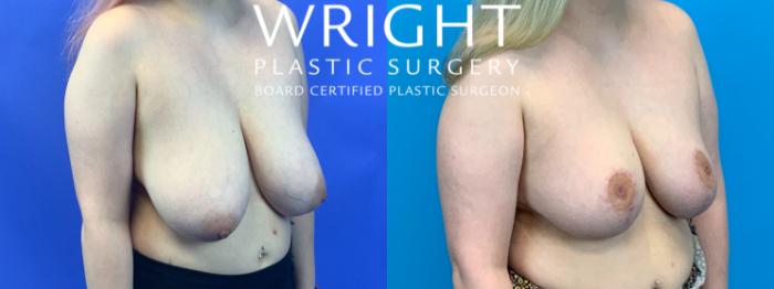 Before & After Breast Reduction Case 181 Right Oblique View in Little Rock, Arkansas