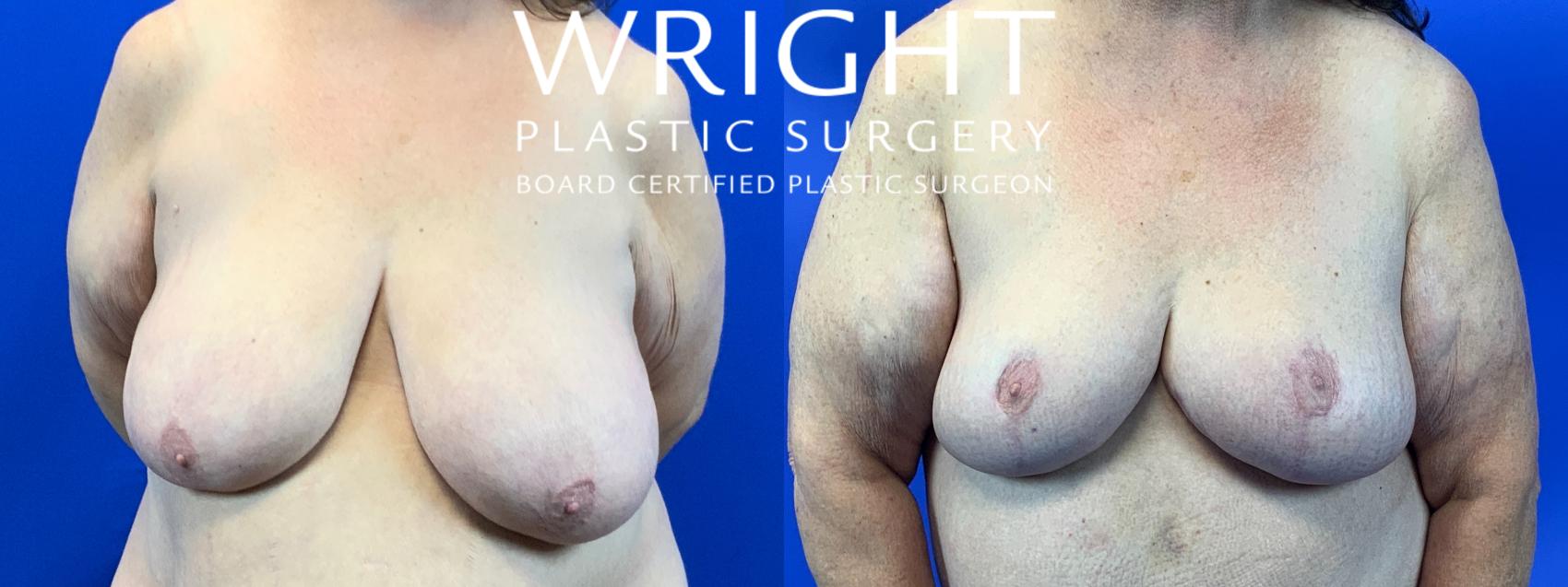 Before & After Breast Reduction Case 185 Front View in Little Rock, Arkansas