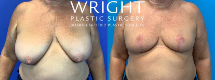 Before & After Breast Reduction Case 198 Front View in Little Rock, Arkansas