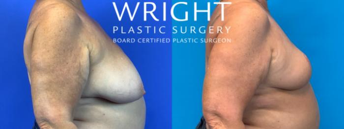 Before & After Breast Reduction Case 198 Right Side View in Little Rock, Arkansas