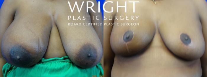 Before & After Breast Reduction Case 20 Front View in Little Rock, Arkansas