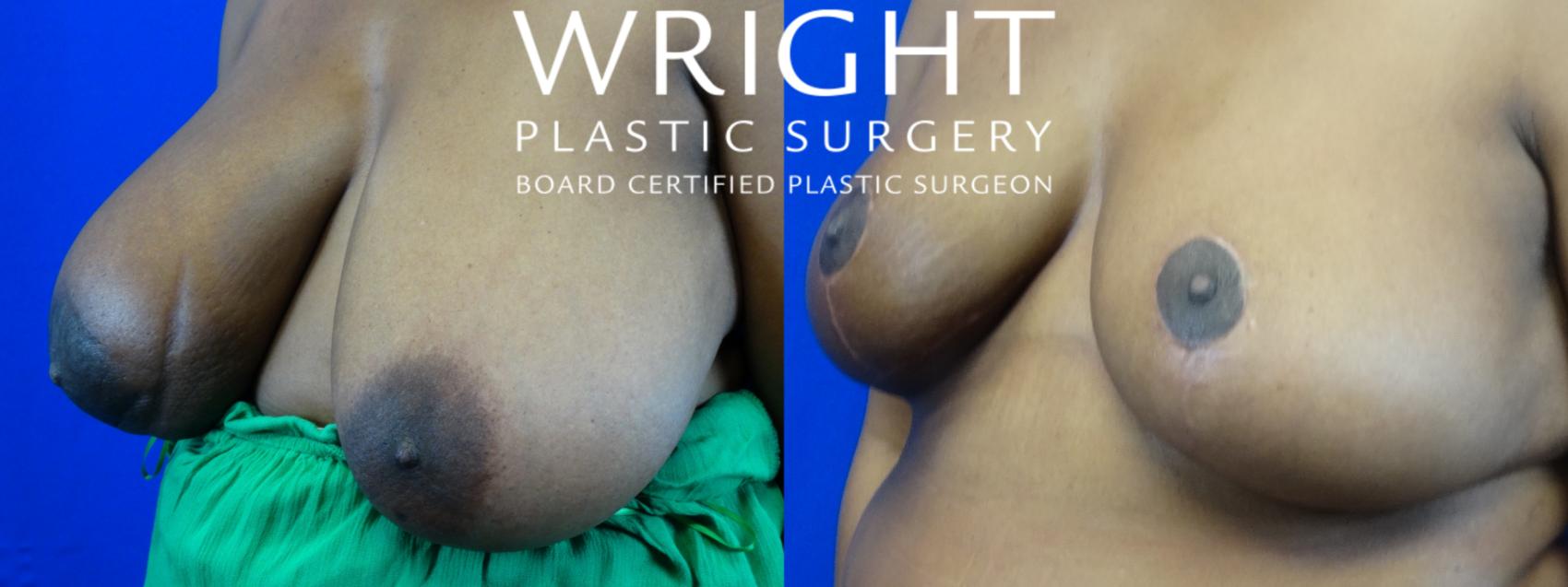 Before & After Breast Reduction Case 20 Left Oblique View in Little Rock, Arkansas