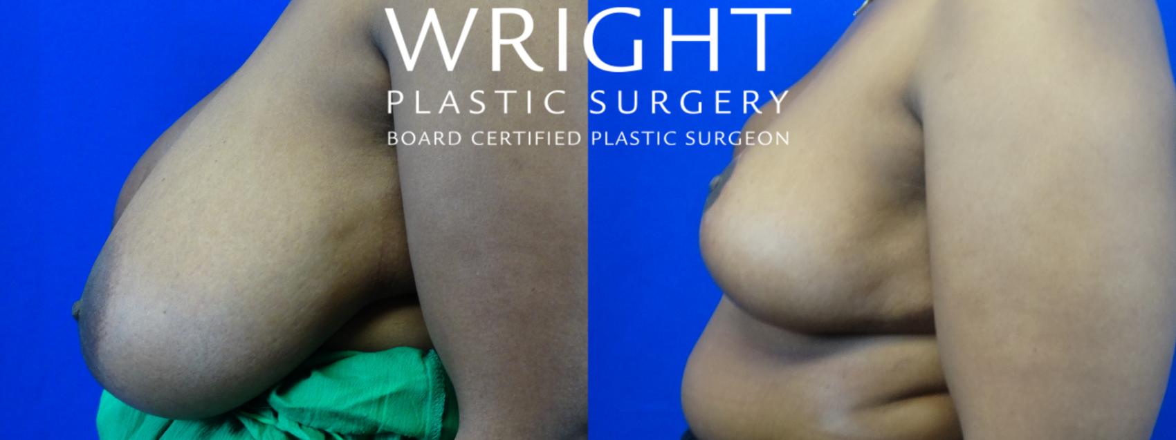 Before & After Breast Reduction Case 20 Left Side View in Little Rock, Arkansas