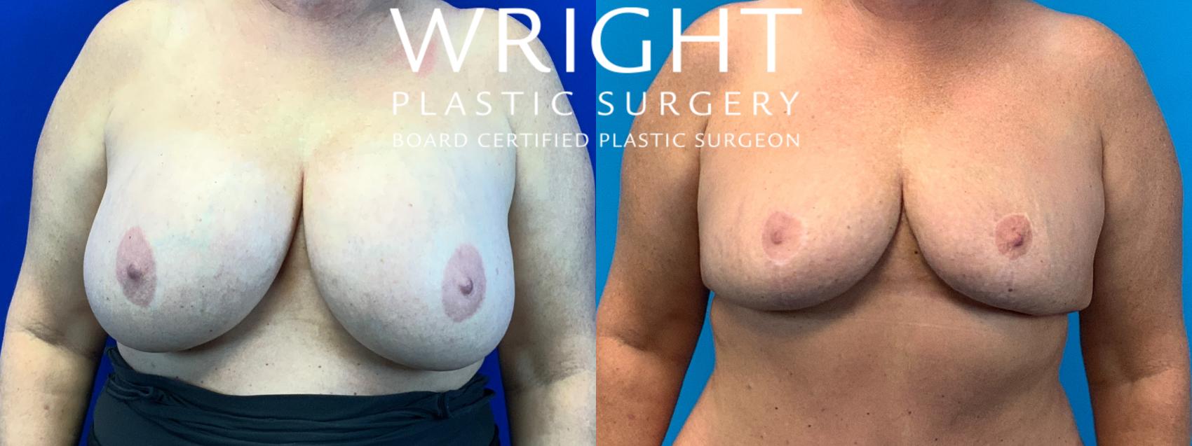 Before & After Breast Reduction Case 202 Front View in Little Rock, Arkansas