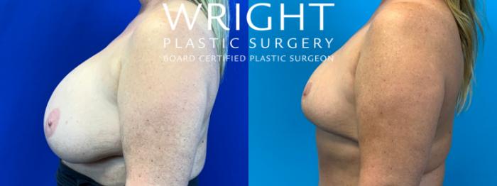 Before & After Breast Implant Removal Case 202 Left Side View in Little Rock, Arkansas