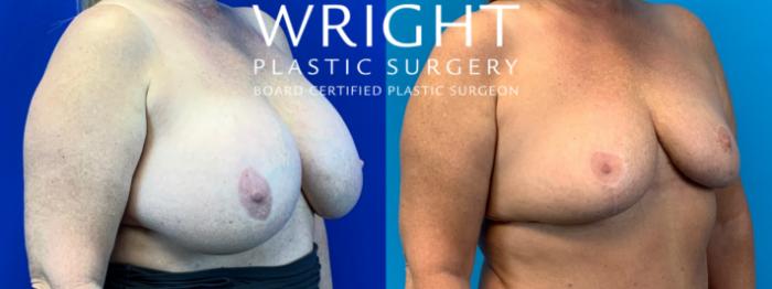Before & After Breast Implant Removal Case 202 Right Oblique View in Little Rock, Arkansas