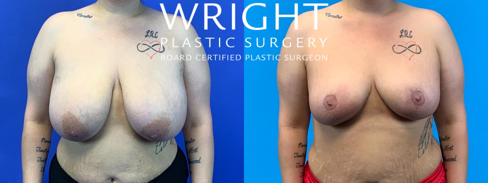 Before & After Breast Reduction Case 204 Front View in Little Rock, Arkansas
