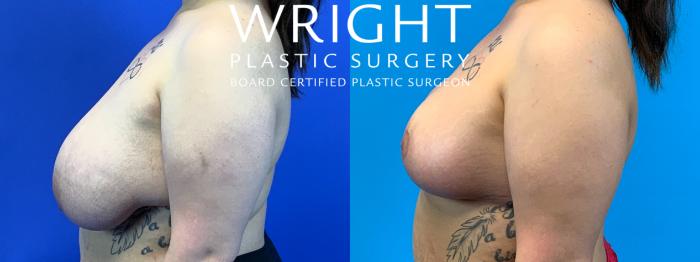 Before & After Breast Reduction Case 204 Left Side View in Little Rock, Arkansas