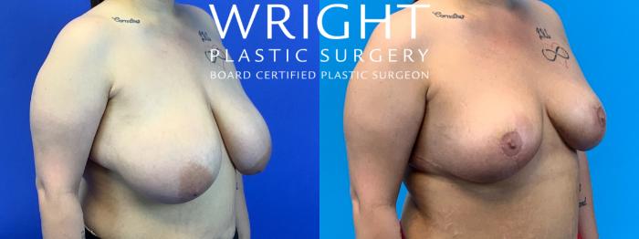 Before & After Breast Reduction Case 204 Right Oblique View in Little Rock, Arkansas