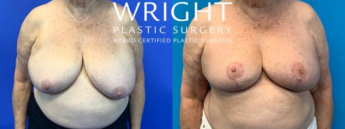Before & After Breast Reduction Case 209 Front View in Little Rock, Arkansas
