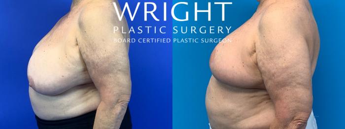 Before & After Breast Reconstruction Case 209 Left Side View in Little Rock, Arkansas