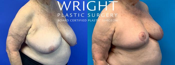 Before & After Breast Reduction Case 209 Right Oblique View in Little Rock, Arkansas