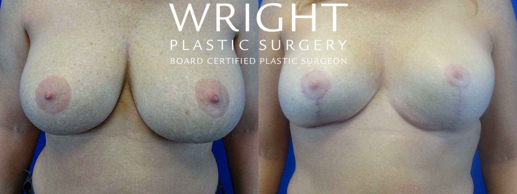 Before & After Breast Reduction Case 21 Front View in Little Rock, Arkansas